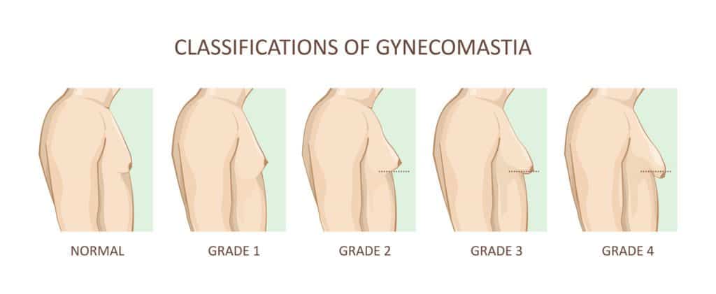 Can Gynecomastia Be Treated with Liposuction